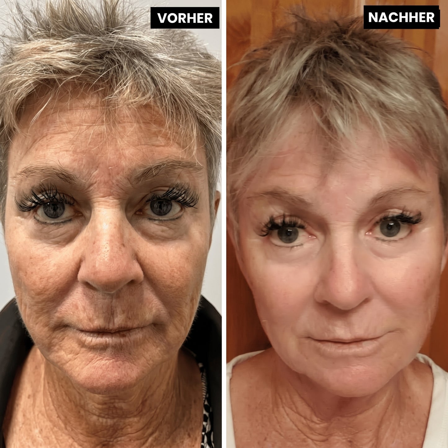 Lyvonelle™ – Die neue Alternative zu Retinol